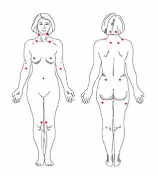 Typical Fibromyalgia Pain Points